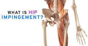 hip impingement management in Mathura 
