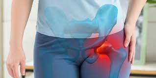 hip impingement management in Mathura 

