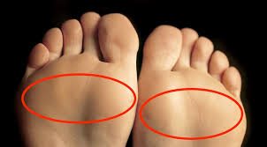 metatarsalgia treatment in Mathura 
