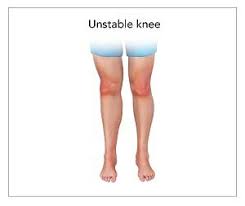 Knee joint instability treatment in Mathura 