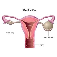 ovarian cyst surgery in Mathura 
