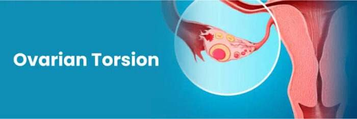 ovarian cyst treatment in Mathura