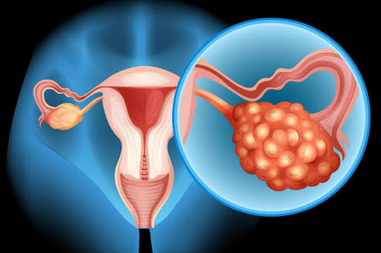 ovarian cyst treatment in Mathura