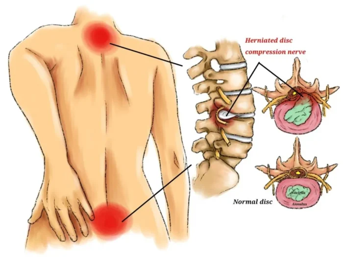 herniated disc treatment exercises bangkok 11 1024x768