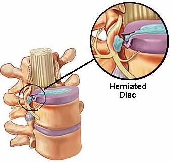 herniated disc treatment in Mathura 

