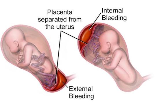 gestational hypertension treatment in Mathura