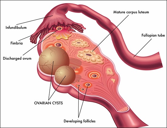 Para Ovarian Cyst
