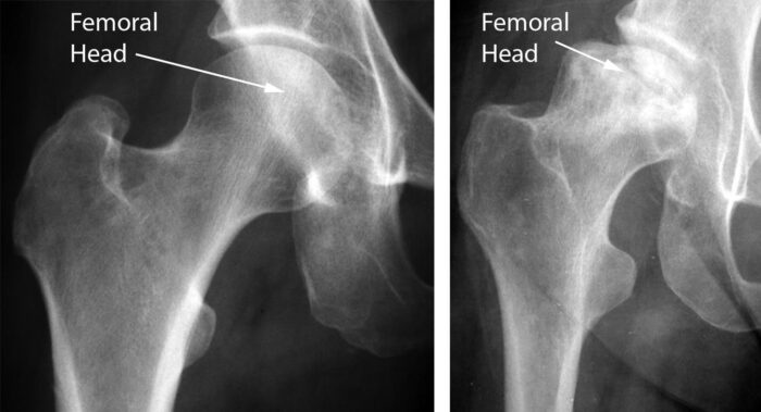 a00216f05 osteonecrosis of the hip emc side by side compressor