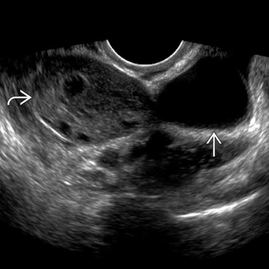 paraovarian cyst treatment in Mathura