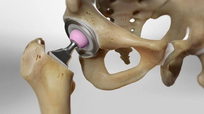 osteonecrosis of femoral head treatment in Mathura